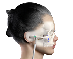 Positioning_of_Zygoma_Reduction_(Cheekbone_Reduction)