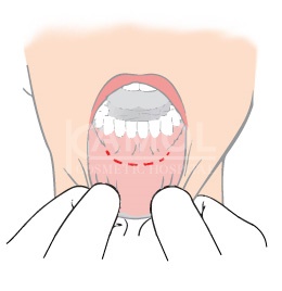 Incision Inside the Mouth