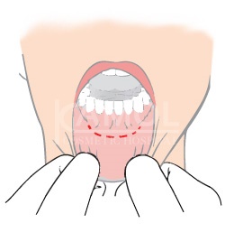 Incision_Inside_the_Mouth