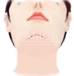 Incision Underneath the Chin