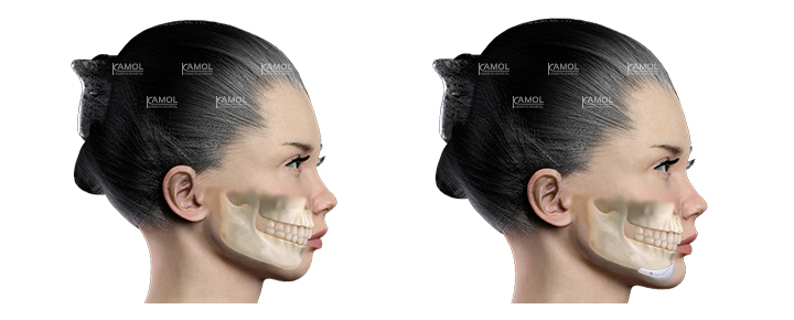 Before_and_after_Chin_Implant_surgery