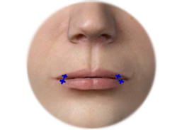ภาพแสดงการผ่าตัดเสริมริมฝีปากด้วยแผ่นเนื้อเยื่อ (Acellular dermal matrix)