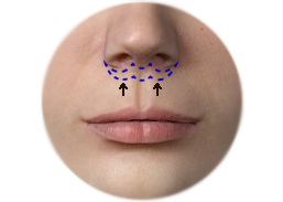 Shows the upper lip lift with the Sub Nasal Bullhorn technique.