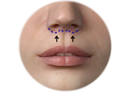 Shows the upper lip lift with the Sub Nasal Bullhorn technique.