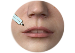 ภาพแสดงการผ่าตัดเสริมการเสริมริมฝีปากโดยการฉีดฟิลเลอร์
