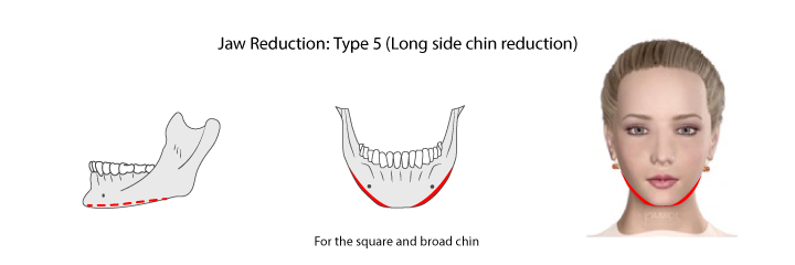 Chin reduction by resecting the bone from chin angle to the middle of the mandible