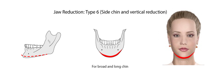 Chin_reduction_at_the_chin_area_by_resecting_and_shortening_a_chin_bone 