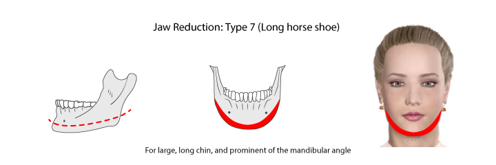 Chin reduction by resecting from side to side of angle jaw through mandible and chin, as “horseshoe” reduction