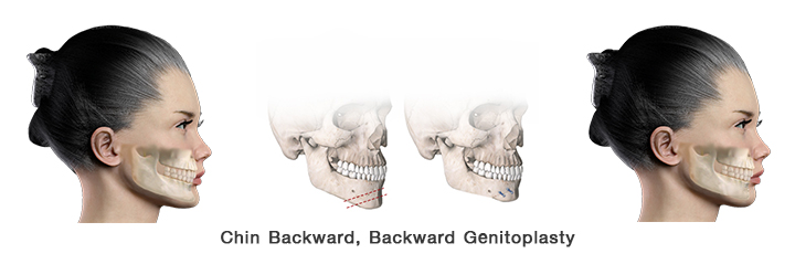 Chin_backward_surgery