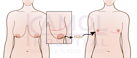 Mastectomy_with_grafting_of_free_nipple_or_double_incision_top_surgery