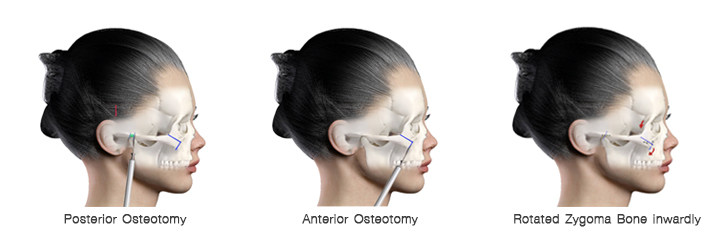 shows Zygomatic Bone, Zygomatic arch