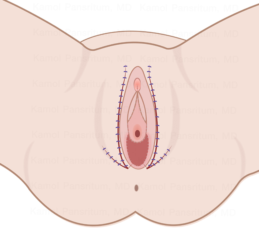  เทคนิคการผ่าตัดแปลงเพศของนายแพทย์กมล_พันธ์ศรีทุม_(มีรอยแผลเป็นอยู่ในร่องของแคมนอกและแคมใน_แทบไม่เห็นรอย)