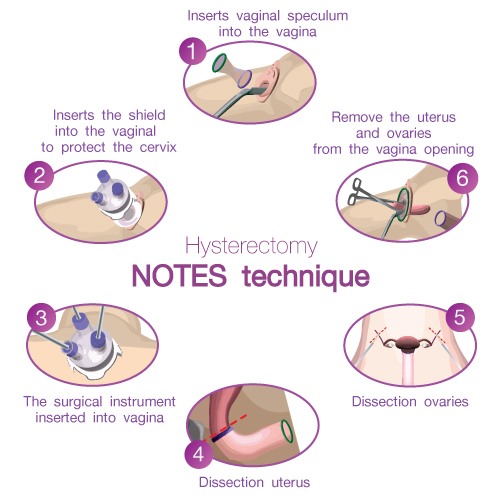 Ooforectomía Laparoscópica Care Guide Information En Espanol