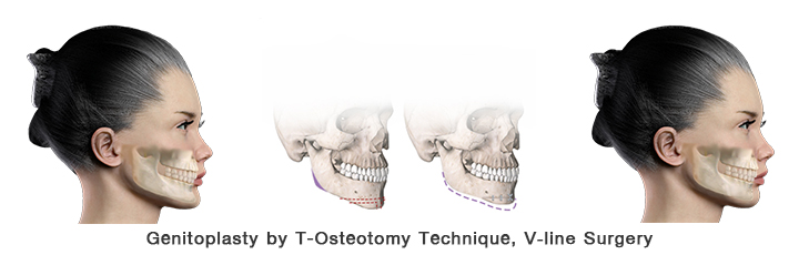 Chin reduction by T-Osteotomy, V-Line surgery