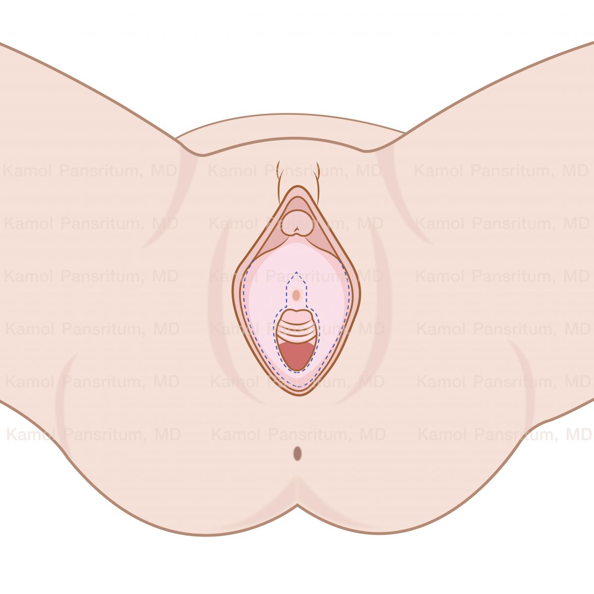 Schematic_of_the_ring_flap_Figure