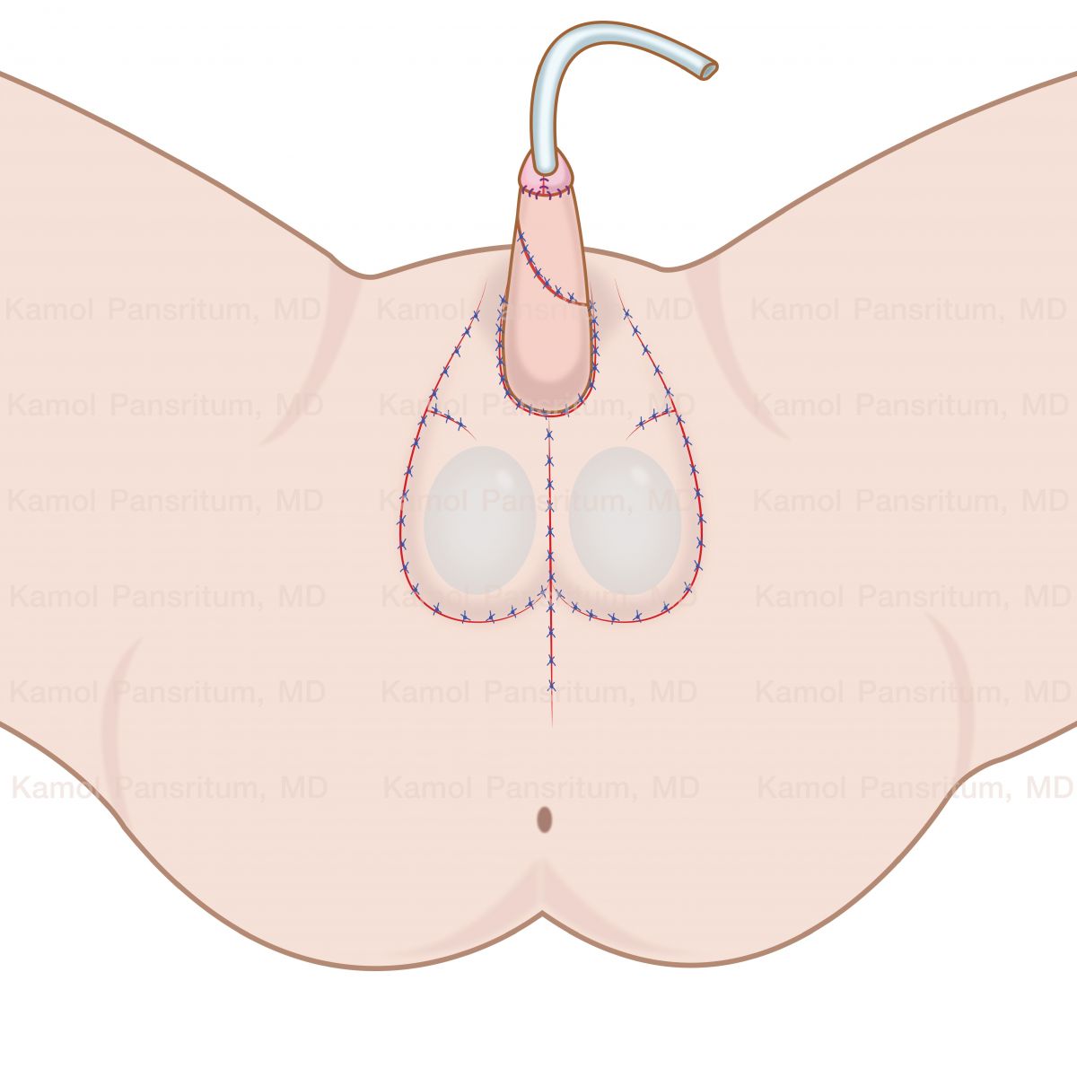 Schematic_of_full_metoidioplasty_with_ring_flap_and_testicular_implants