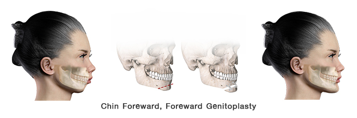 Chin forward surgery