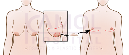 Mastectomy with grafting of free nipple