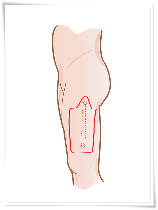 ALT-Pedicle Flap