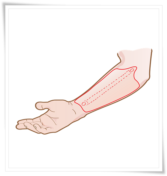 Radial_Forearm_Free_Flap