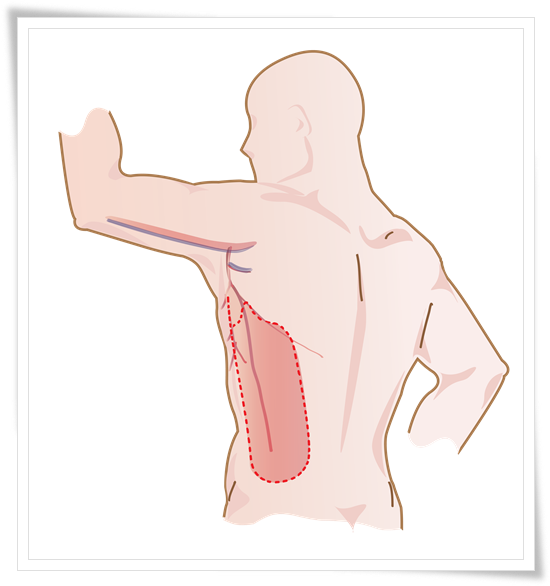 Musculocutaneous_Latissimus_Gorsi_MLD