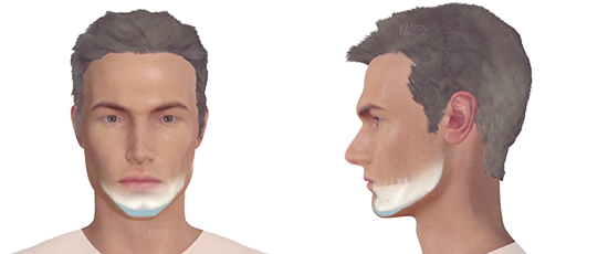Chin contouring (Genitoplasty / Mentoplasty)