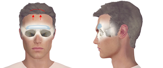 Forehead Lengthening & Augmentation