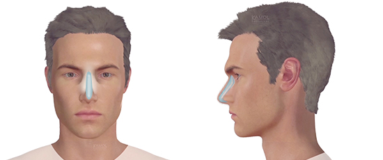 Rhinoplasty (Nose Augmentation)