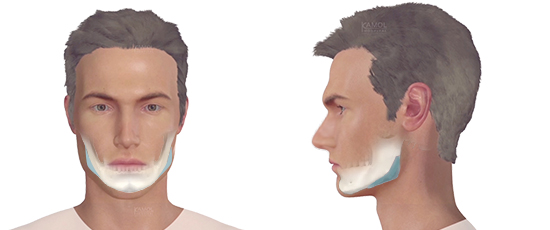 Jaw Reshaping / Jaw Augmentation