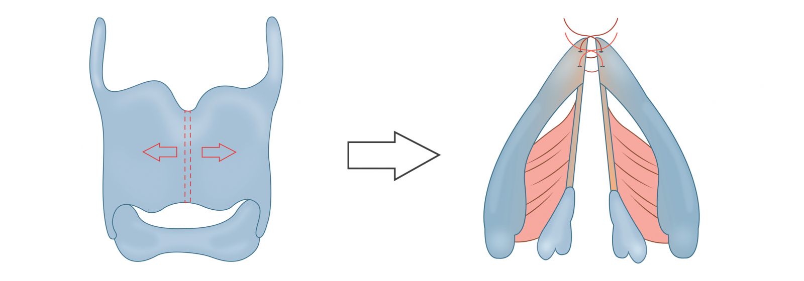 reduce_laryngeal_diameter