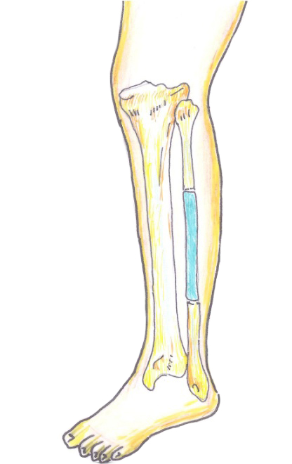 ตำแหน่งกระดูก  Fibula ที่ถูกตัดออกไป