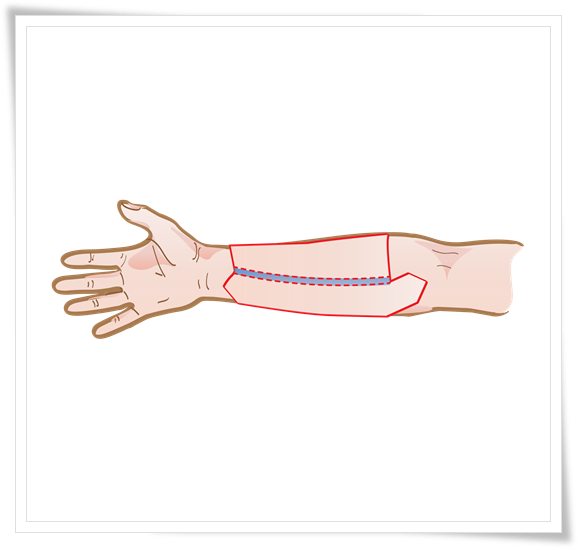 Radial Forearm Free Flap