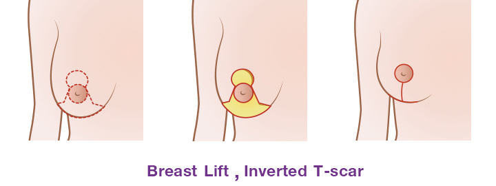 The incision around areolar, vertical down from the areolar to breast crease and horizontally along the breast crease. ( Inverted T -Scar)