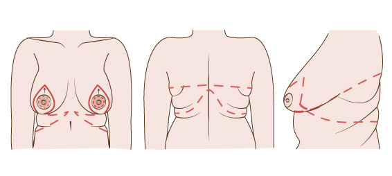 Incision_line_of_the_upper_body_lift.