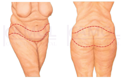 the_incision_line_for_belt_lipectomy_or_truncal_body.