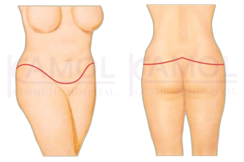 Shows the incision scar for belt lipectomy or truncal body.