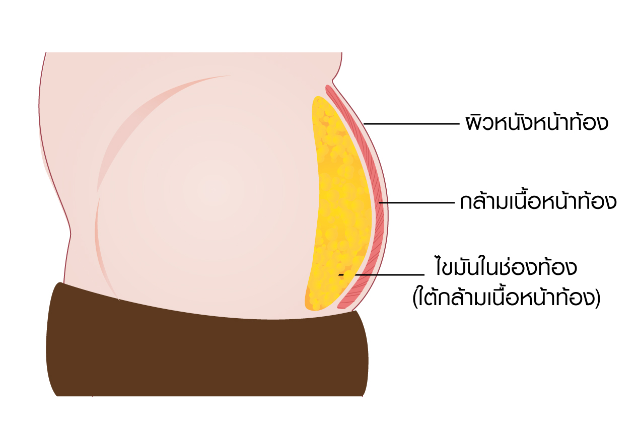 ดูดไขมันไม่เห็นผล_เพราะอะไร?