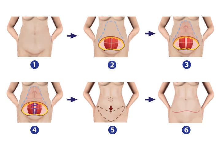 Abdominoplasty (Tummy Tuck)