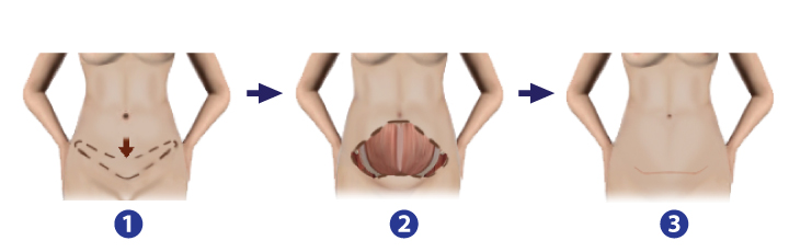 แสดงการผ่าตัดแบบไม่ย้ายสะดือ (Mini Abdominal Lipectomy) 