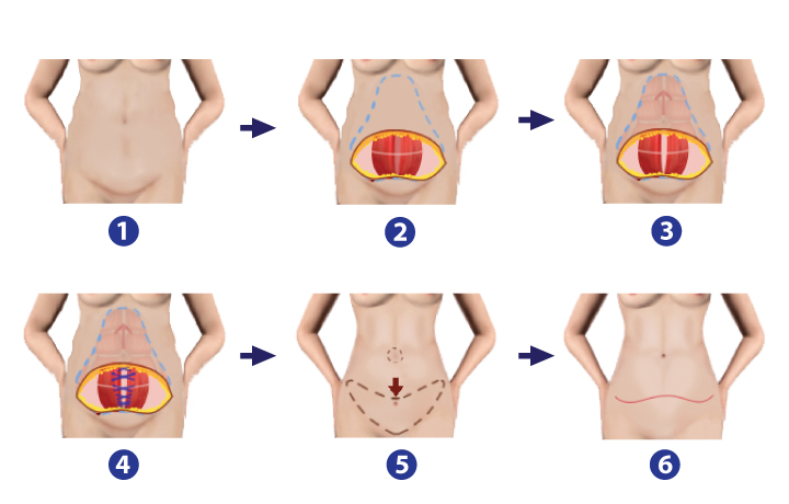 Shows the procedure of Abdominoplasty /tummy tuck with umbilical transposition and repairing the sagging abdominal muscles