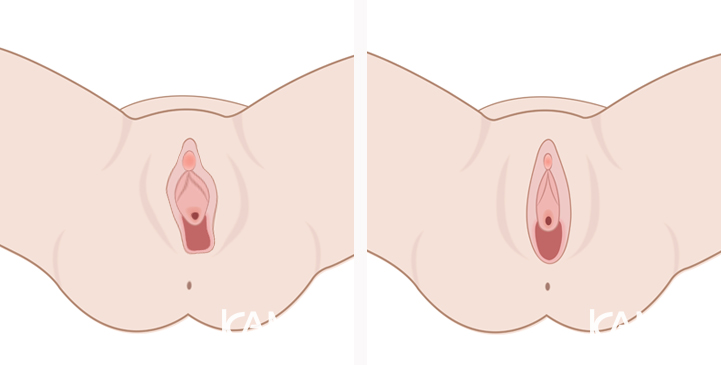 Revision_Vaginoplasty