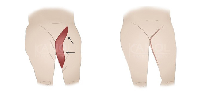 inner_thigh_incision_and_scar