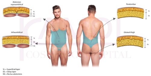 Positioning of the excess fat sucking to perform six-pack in a male body