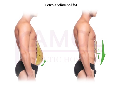 The area of subcutaneous fat and six pack creation