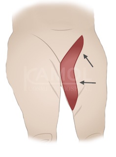 The inner thighs incision