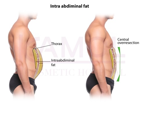 The area of excess fat above and below abdominal cavity and six pack creation