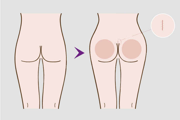 buttock surgery by Buttock Implants