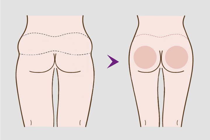 Buttock Lifts 
