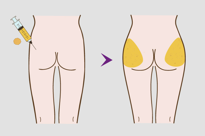 Buttock Augmentation by Fat Graft