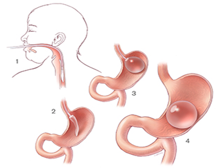 Gastric_Balloon_procedures 